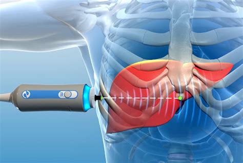 Fibroscan to check for liver inflammation .